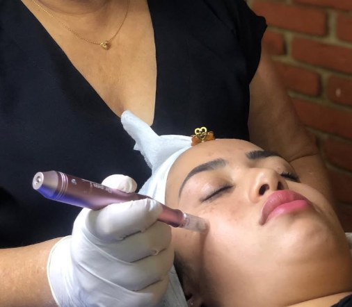 Profissional da ABBA realizando microagulhamento facial