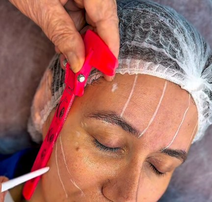 Mapeamento facial com marcações antes do procedimento